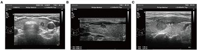 A Nomogram Based on Clinicopathological and Ultrasound Imaging Characteristics for Predicting Cervical Lymph Node Metastasis in cN0 Unilateral Papillary Thyroid Microcarcinoma